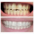 New Extra-Strength Teeth Whitening Serum For Discount